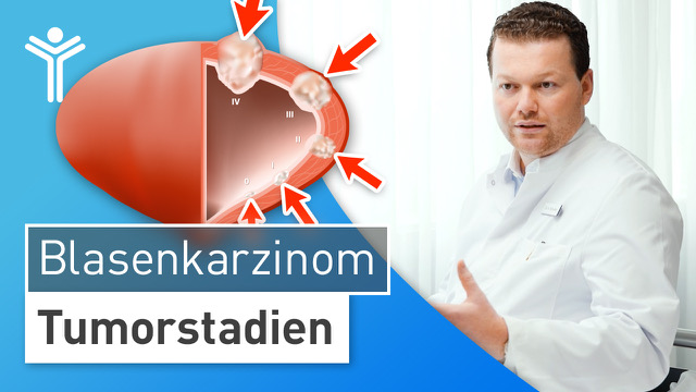 Blasenkarzinom - Tumorstadien