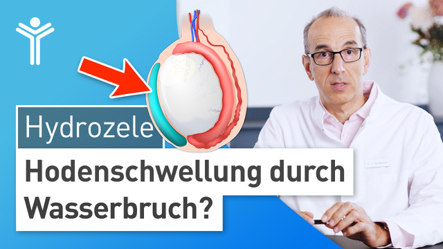 Hydrozele - Hodenschwellung durch Wasserbruch?